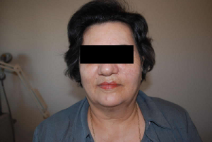 Face after IPL Limelight Treatment