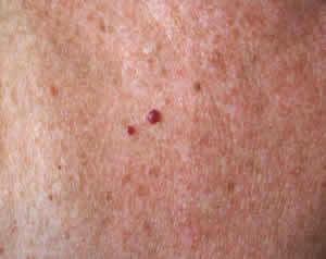 Cherry Angioma photographed close up.