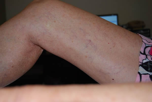 Leg Veins treated by Laser Vascular treatment