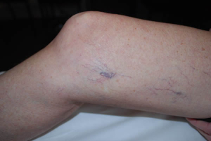 Laser Vascular treatment of Leg Veins