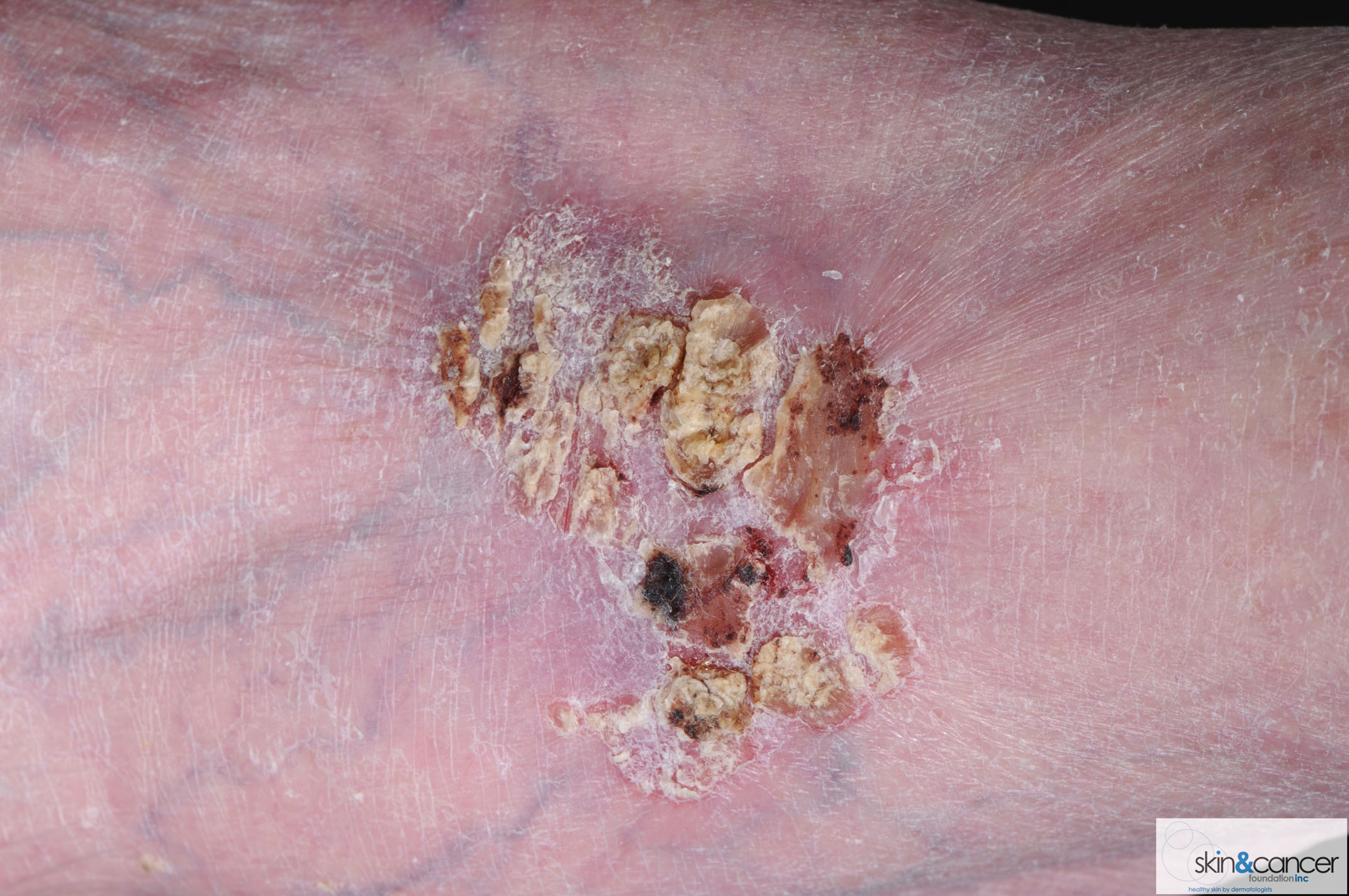 Skin Cancer Foundation - Squamous Cell Carcinoma